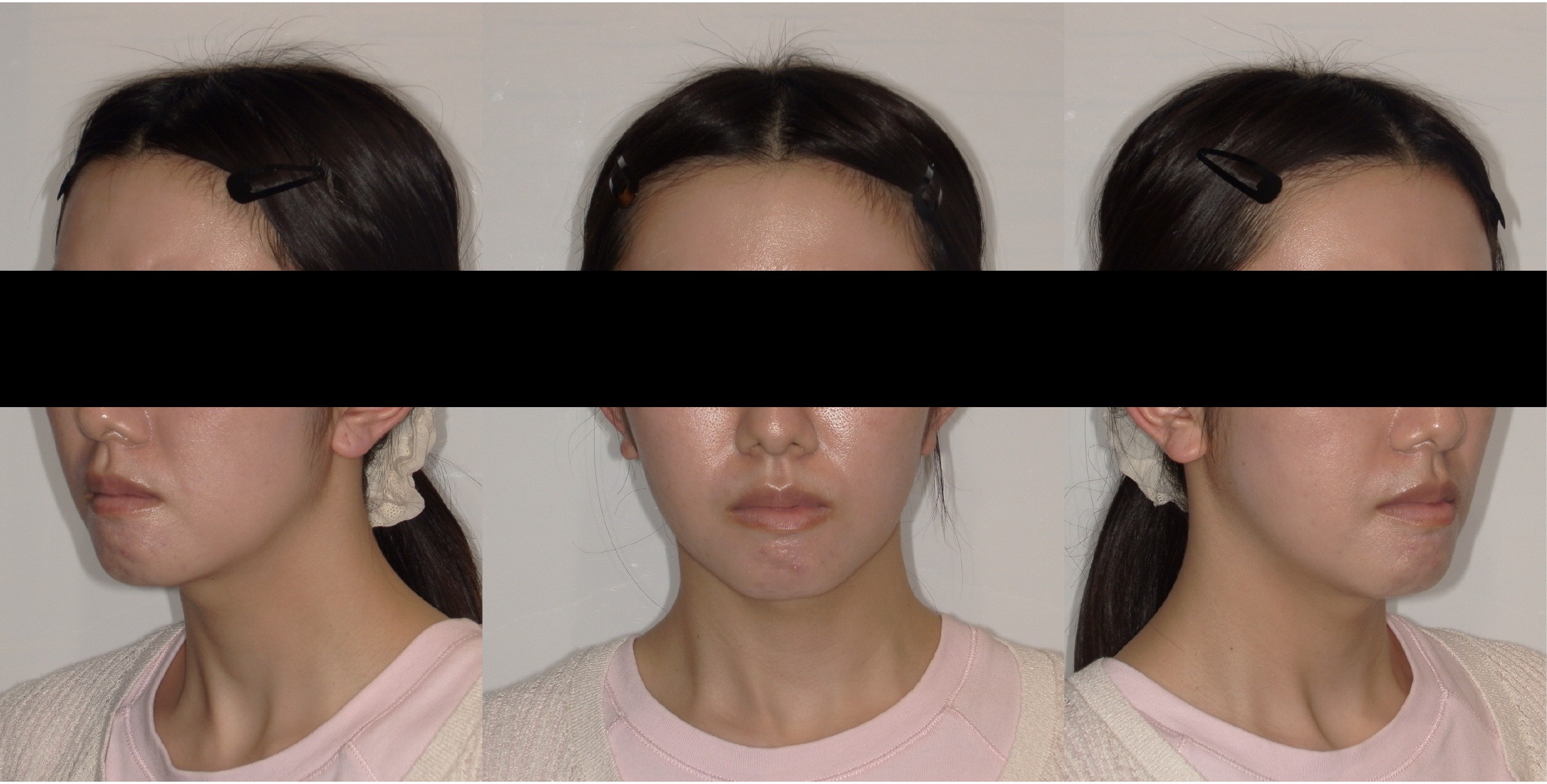Patient 1 — left, front and right views after jaw surgery