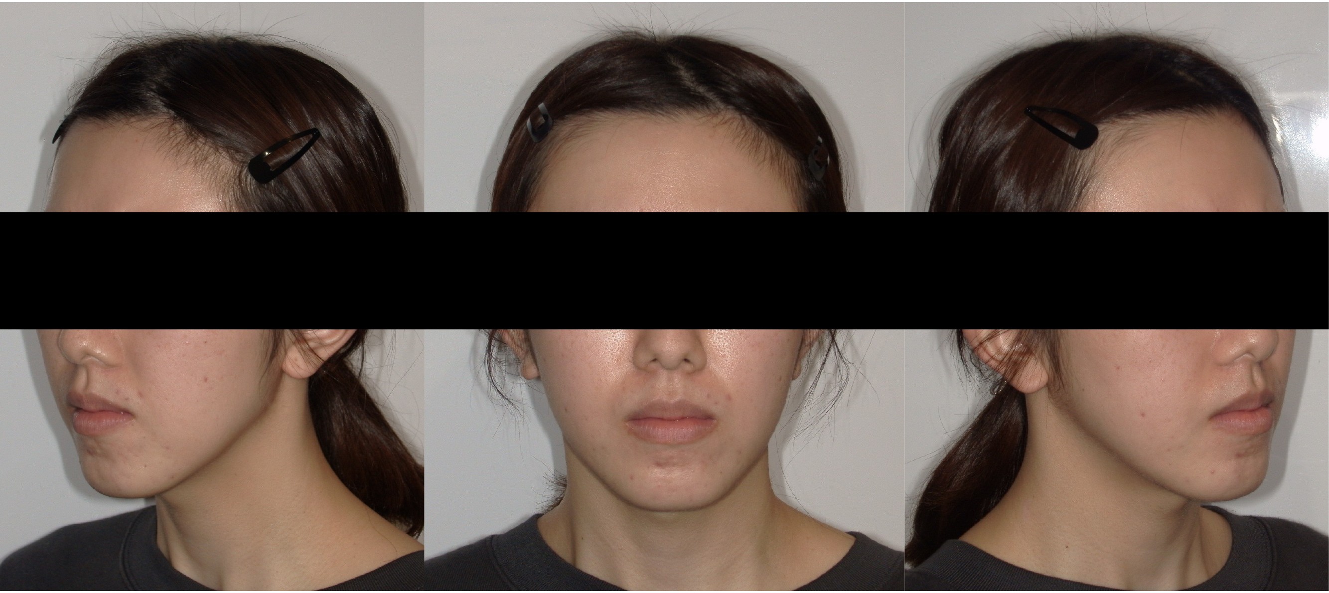 Patient 1 — left, front and right views before jaw surgery