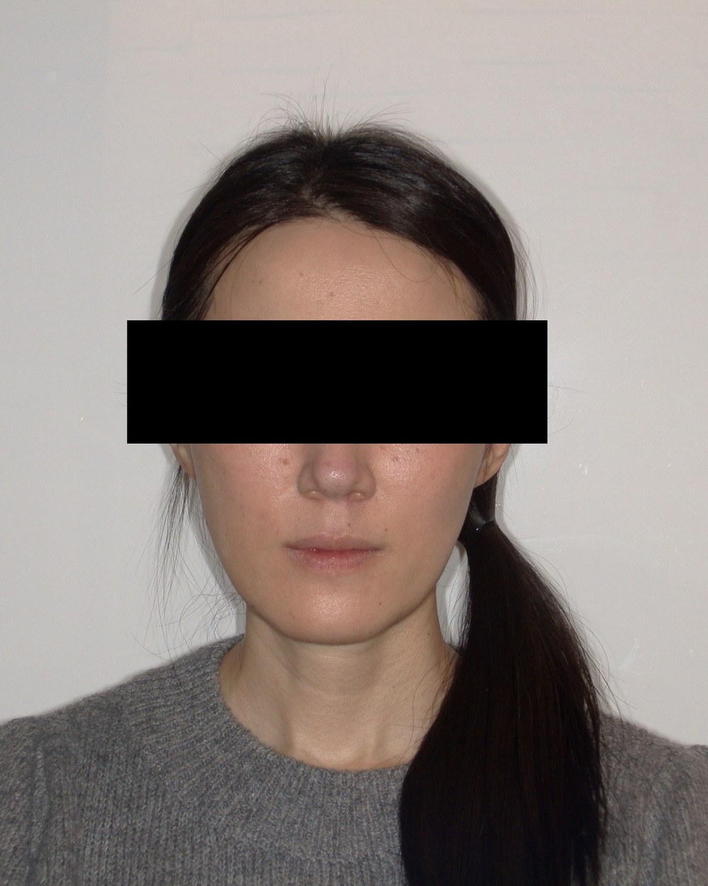 Patient 2 — front, after jaw surgery