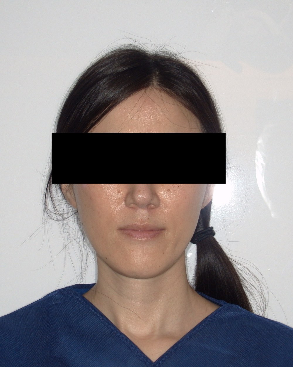Patient 2 — front, before jaw surgery