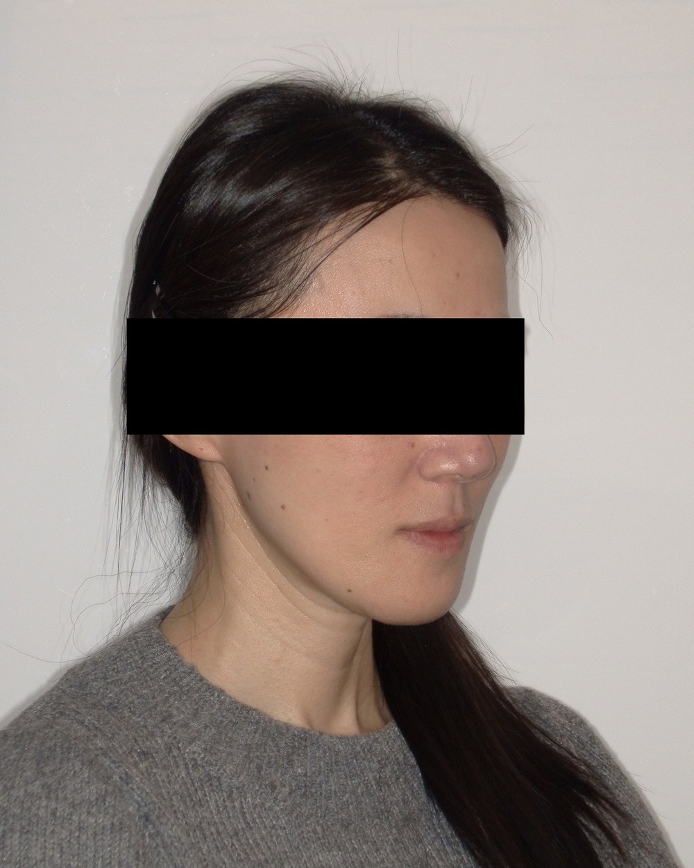 Patient 2 — left side, after jaw surgery