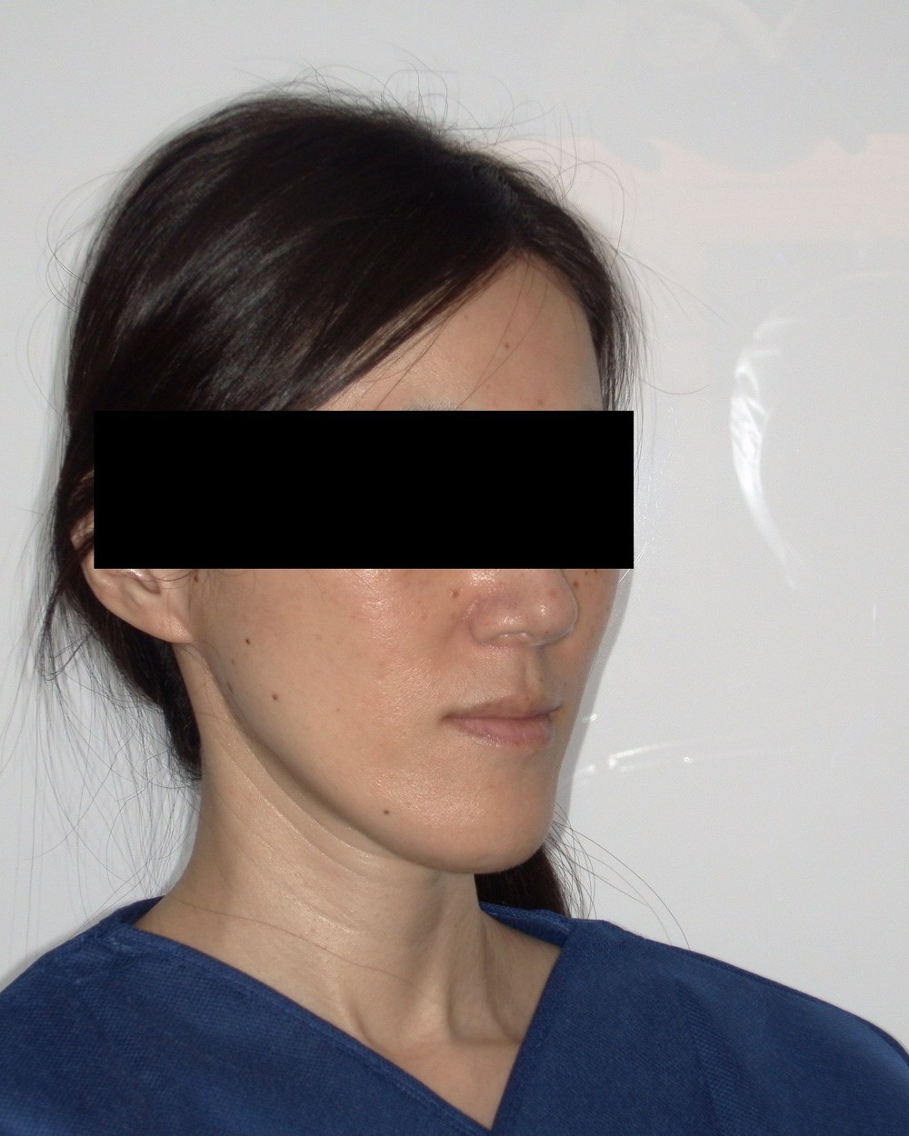 Patient 2 — left side, before jaw surgery