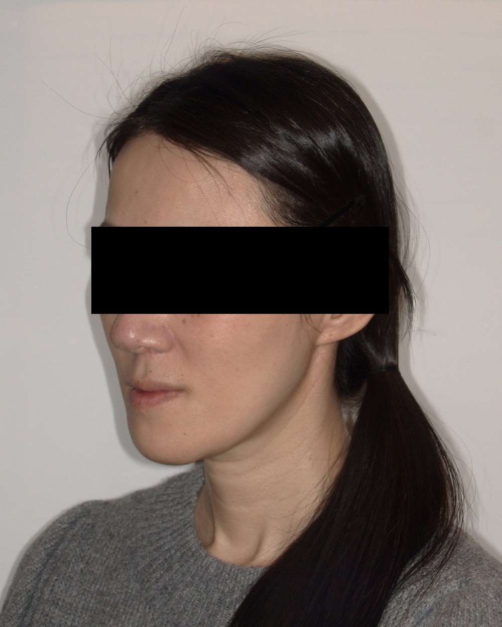 Patient 2 — right side, after jaw surgery