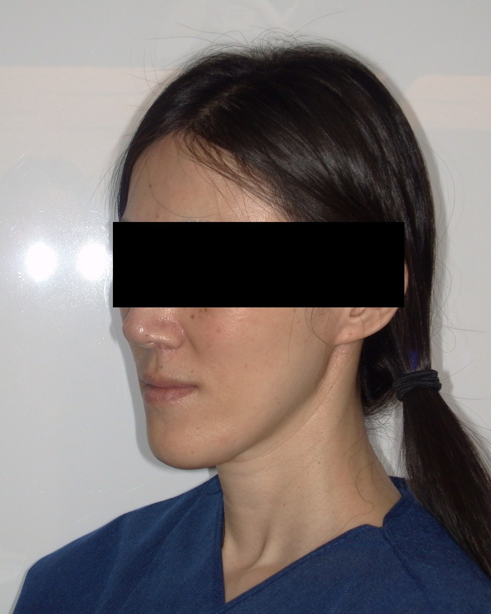 Patient 2 — right side, before jaw surgery